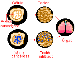 A Leucemia Pode se Espalhar para outros Órgãos?